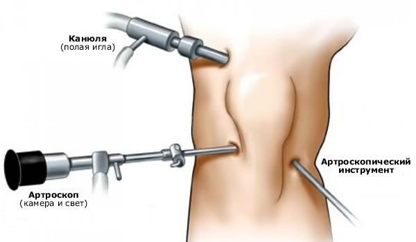 Artroscopia dell'articolazione del ginocchio