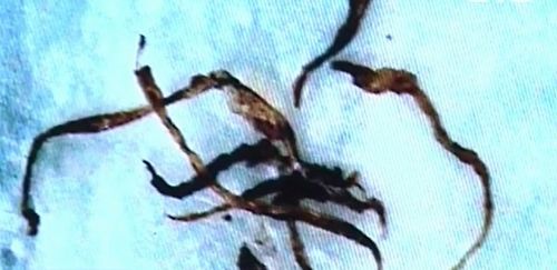 La malattia di Morgellons esiste e potrebbe essere collegata agli OGM