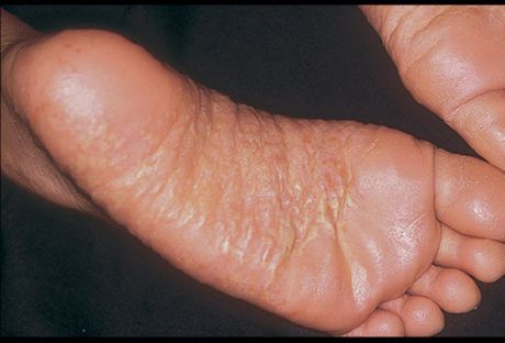 Dermatite delle gambe e le sue cause