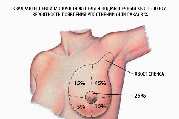 Quadranti mammari sinistri e coda ascellare di Spence. Probabilità di sviluppare noduli (o cancro) in %.