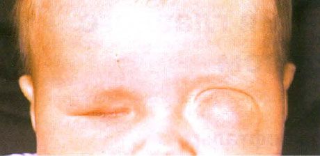 Microftalmo con formazione di cisti associata (occhio sinistro). Anoftalmo (occhio destro).