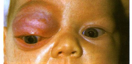 Emangioma capillare della parte anteriore dell'orbita e palpebra superiore.  Il neoplasma tende a progredire