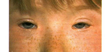 Sindrome da blefarofimosi. Ptosi bilaterale, telecanto e blefarofimosi.