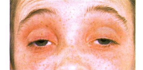 Oftalmoplegia esterna. Ptosi bilaterale. Il paziente apre gli occhi sollevando le sopracciglia.