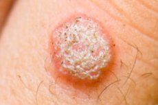 Papilloma virus incubazione. HPV (PAPILLOMA VIRUS) : UNA PROPOSTA DI CURA hpv virus positivo