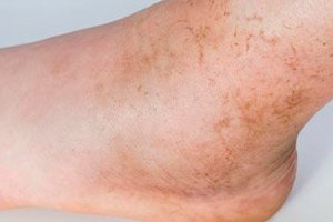 Macchie Marroni Sulle Gambe Che Cos E E Cosa Fare Con Competenza Per La Salute Su Ilive