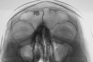 Osteoma Del Seno Frontale Sintomi Trattamento Con Competenza Per La Salute Su Ilive
