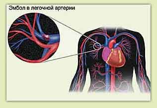 Embolia polmonare e dolori al petto a sinistra