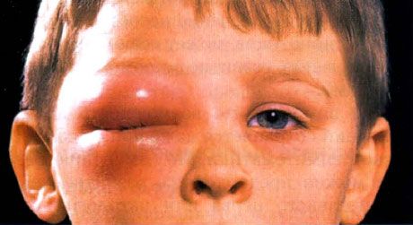 Cellulite extraorbitale nei bambini